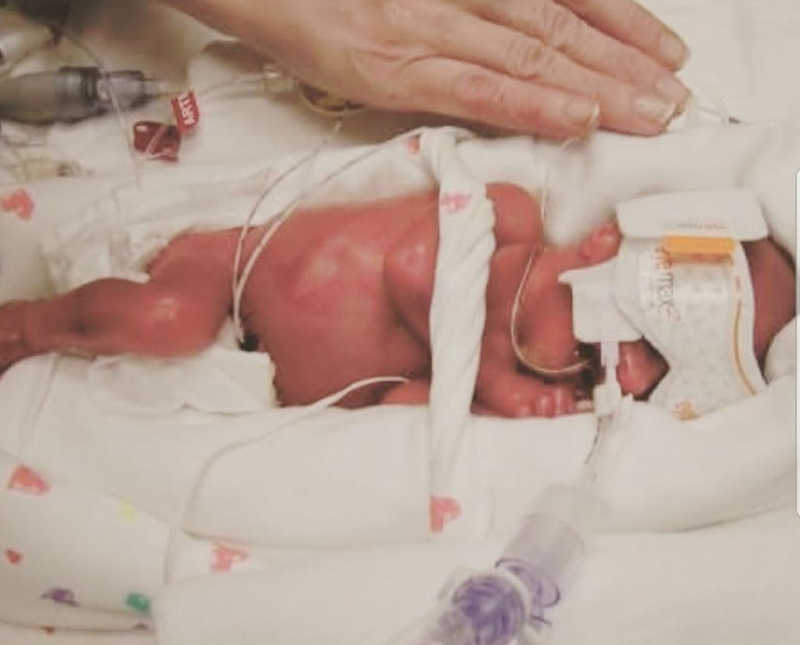 Intubated preemie lays asleep in NICU with eye covers on