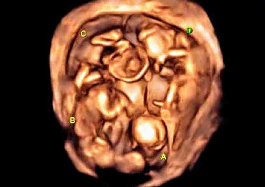 Ultrasound of quadruplet babies