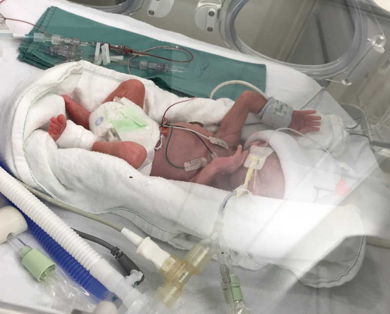 Intubated newborn lays on back in NICU