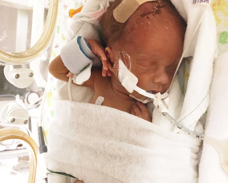 Intubated preemie lays asleep in NICU