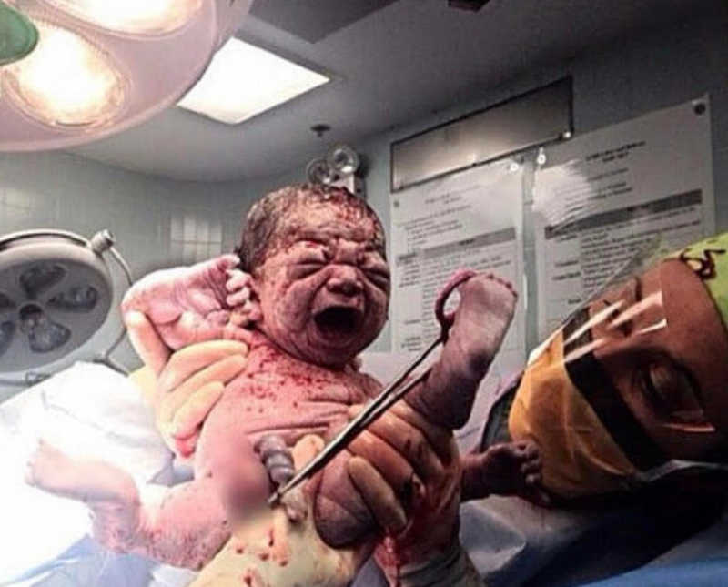Doctor holds up bloody newborn in air
