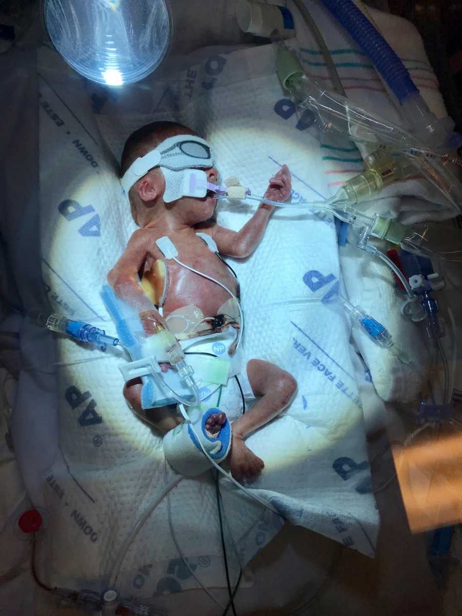 Newborn lays in ICU under bright light with eye covers on