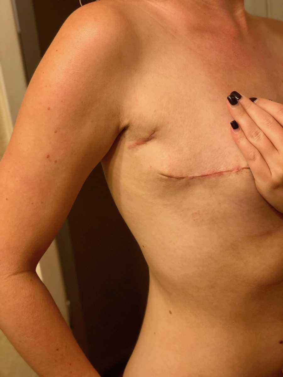 Bare chest of woman with scars on it after having surgery