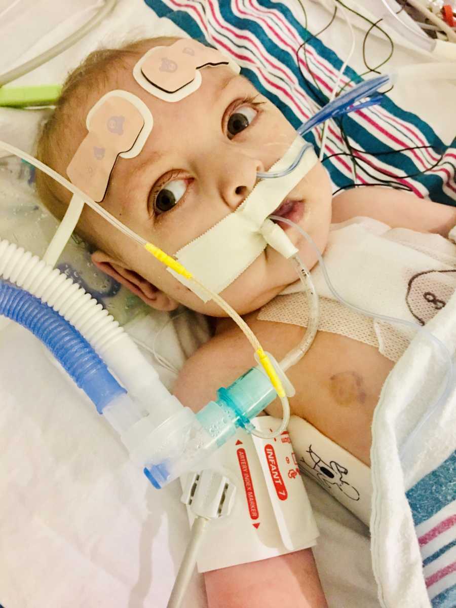 Intubated baby with Hypoplastic Left Heart Syndrome lays on back in hospital