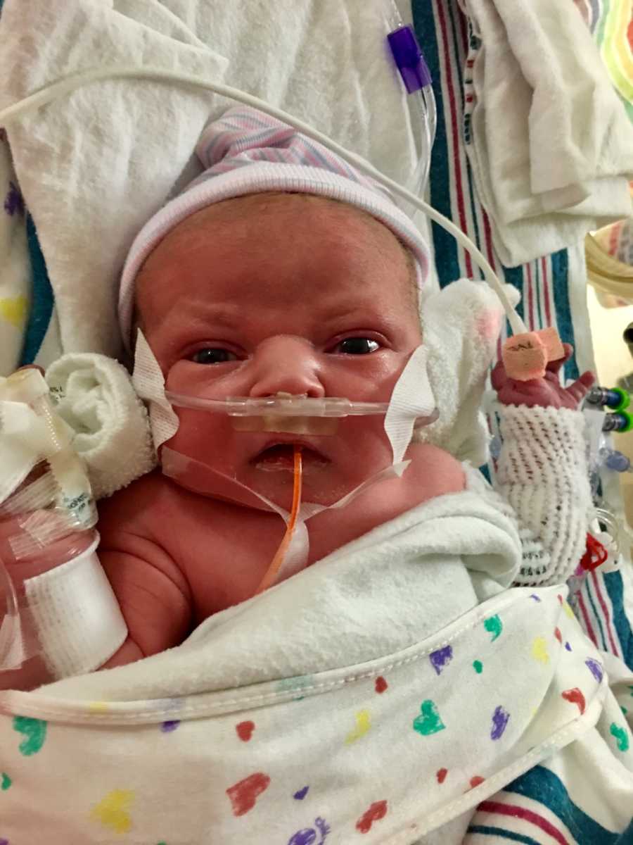 Intubated newborn lays on back in NICU with Hypoplastic Left Heart Syndrome