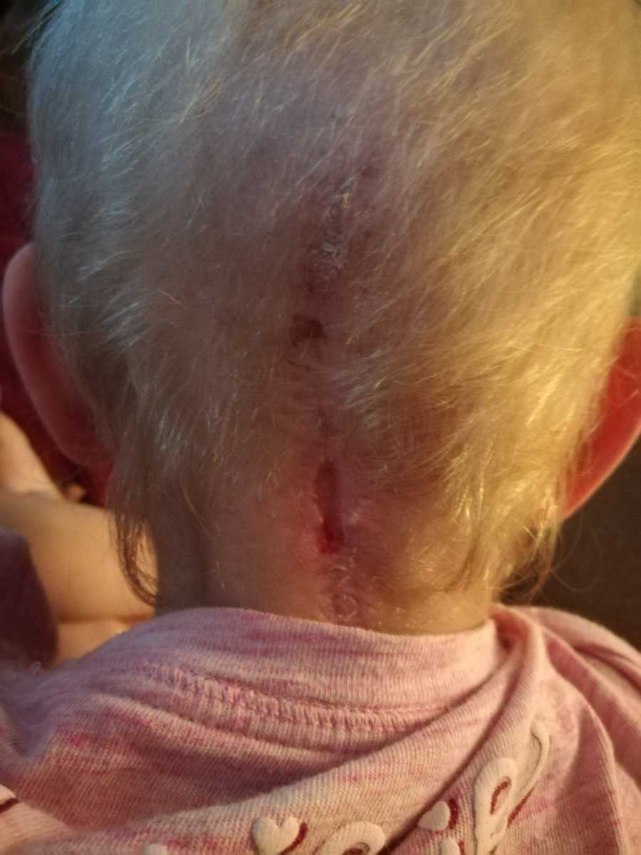 Back of little girl's head that has scar from surgery