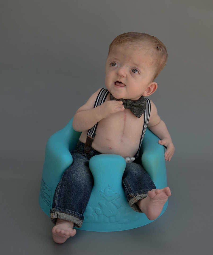 Little boy with Apert syndrome sits in baby chair wearing jeans, suspenders and bow tie