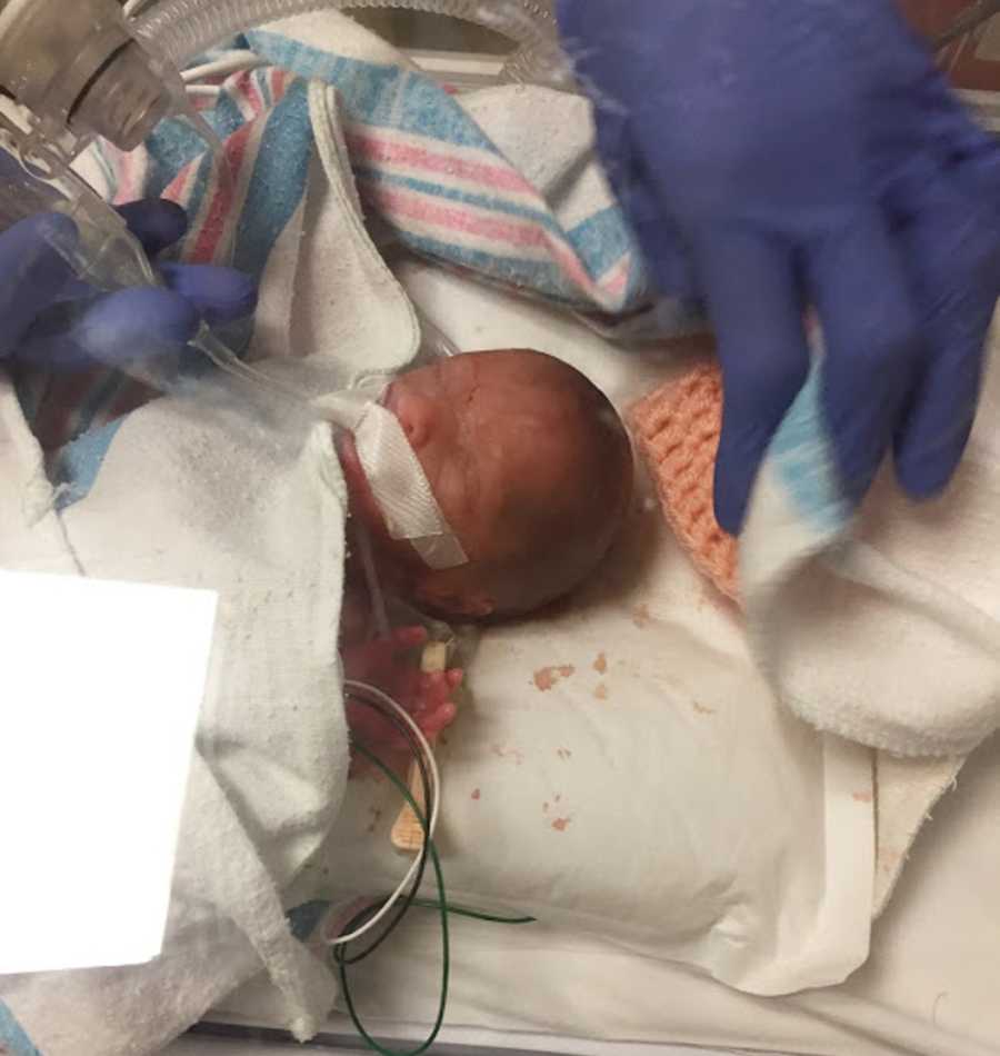 Intubated preemie lays asleep in NICU