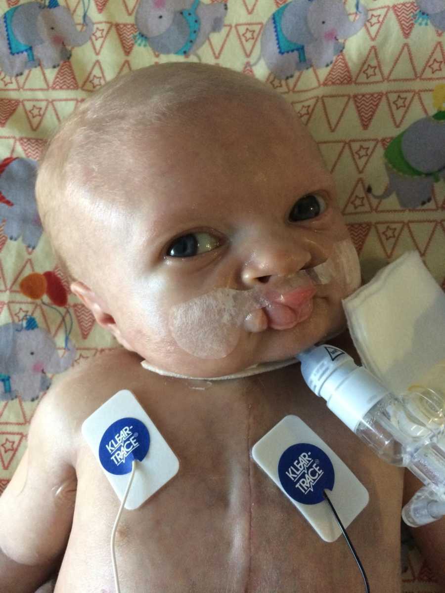 Newborn with charge syndrome and heart defects lays on his back with trach 