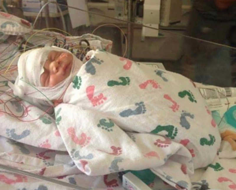Newborn with Factor V Leiden lays in NICU swaddled in hospital blanket with bandages wrapped around his head