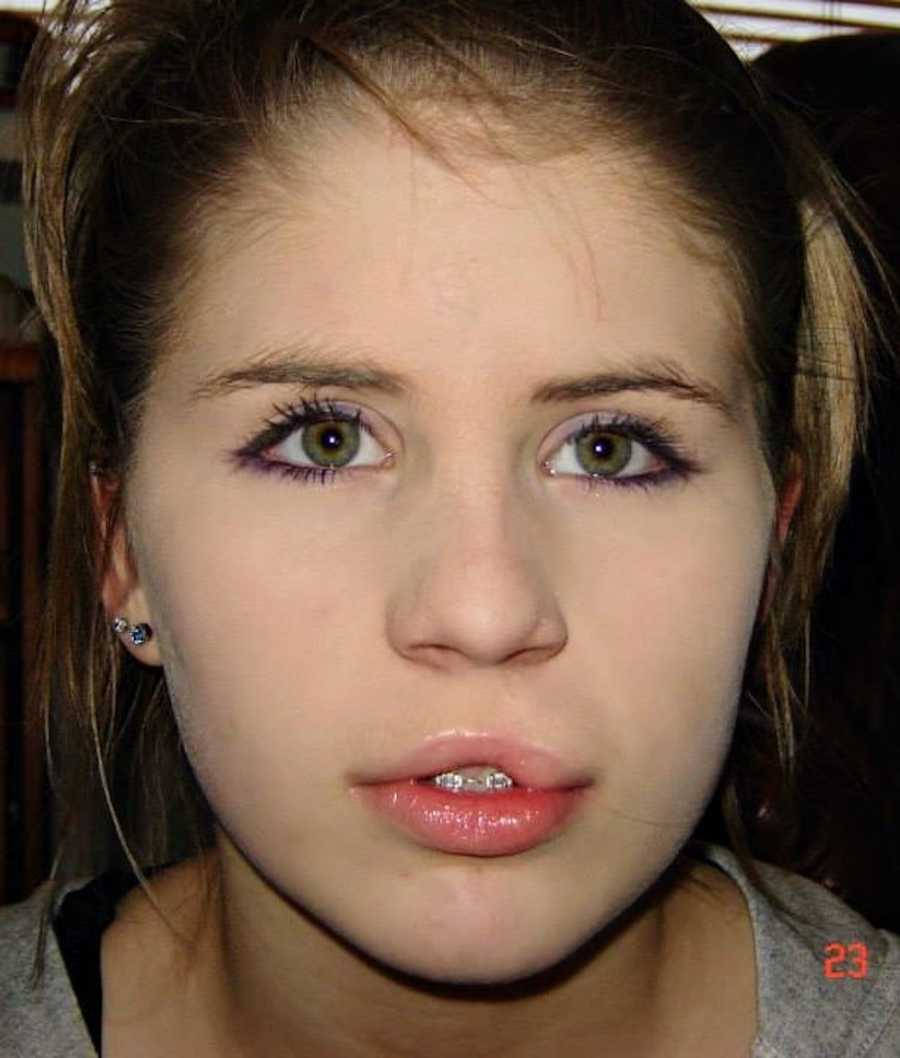 Young woman's face with cleft lip