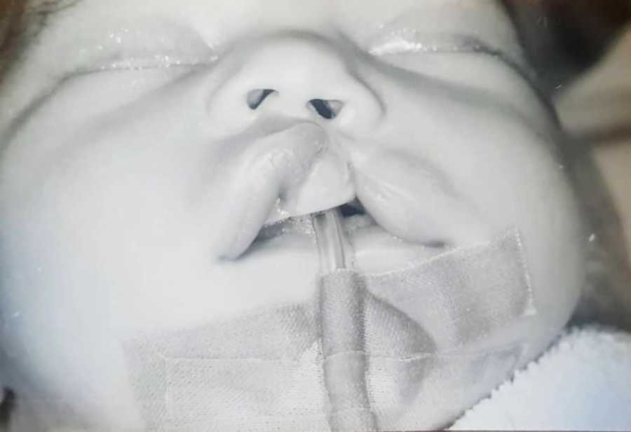 Intubated newborn with cleft lip