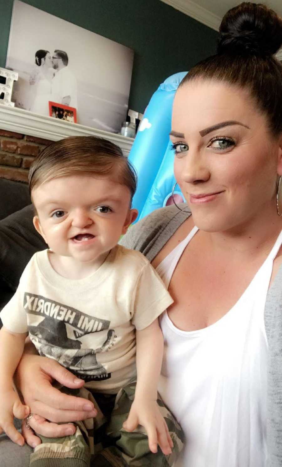 Mother smiles in home as her son with Apert syndrome sits on her lap