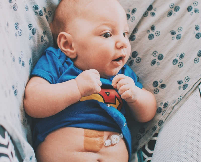 Baby lays on back with shirt raised to expose G-tubes