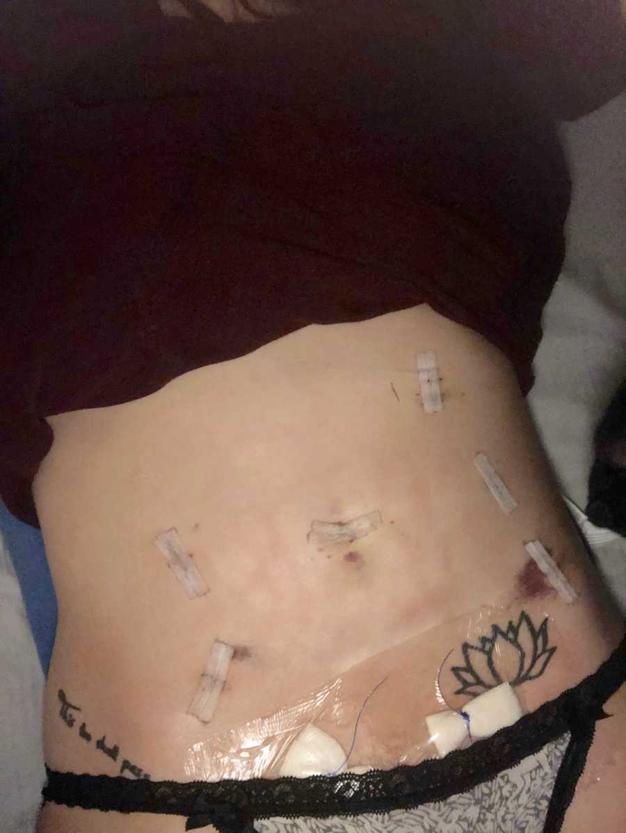 Stomach of woman who had endometriosis surgery and has scars and bandages all over it