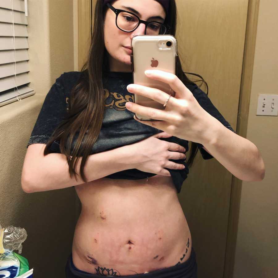 Woman who had endometriosis surgery takes mirror selfie in bathroom as she holds shirt up to show scars on her stomach