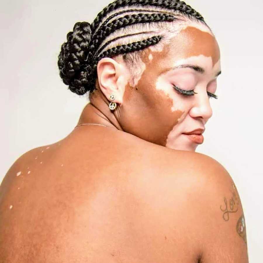 Woman with vitiligo sits shirtless as she holds her head to her side