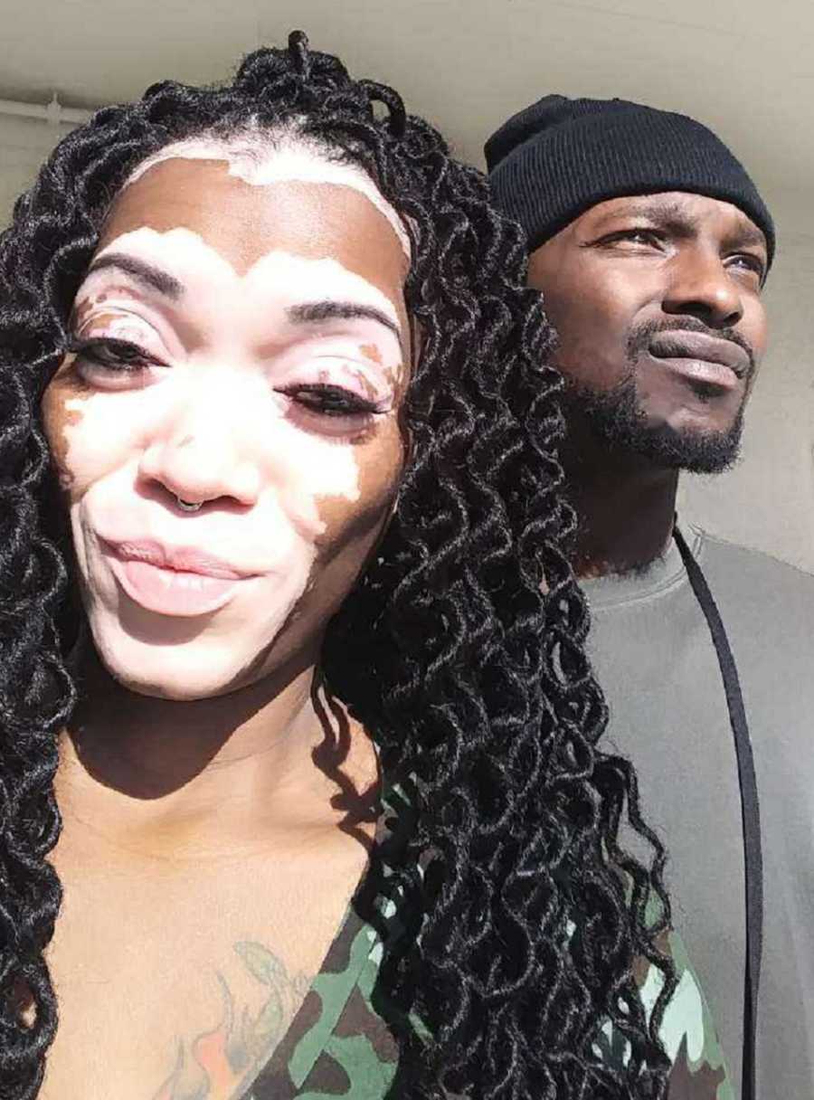 Woman with vitiligo stands smiling with her husband in background