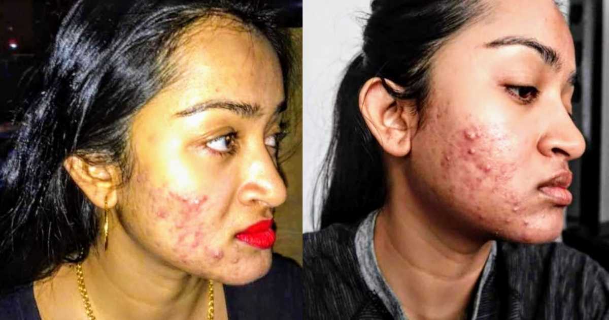 ‘I couldn’t hide the huge bumps on my face. I felt hideous. I couldn’t