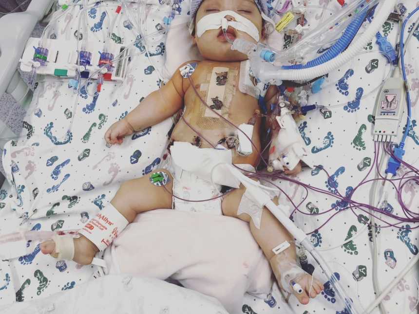 Intubated baby lays in hospital with low resting heart rate and suspicion of down syndrome