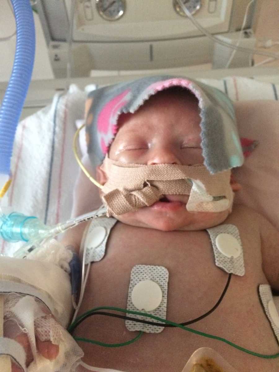 Intubated baby with tumor lays in NICU with patches on her chest