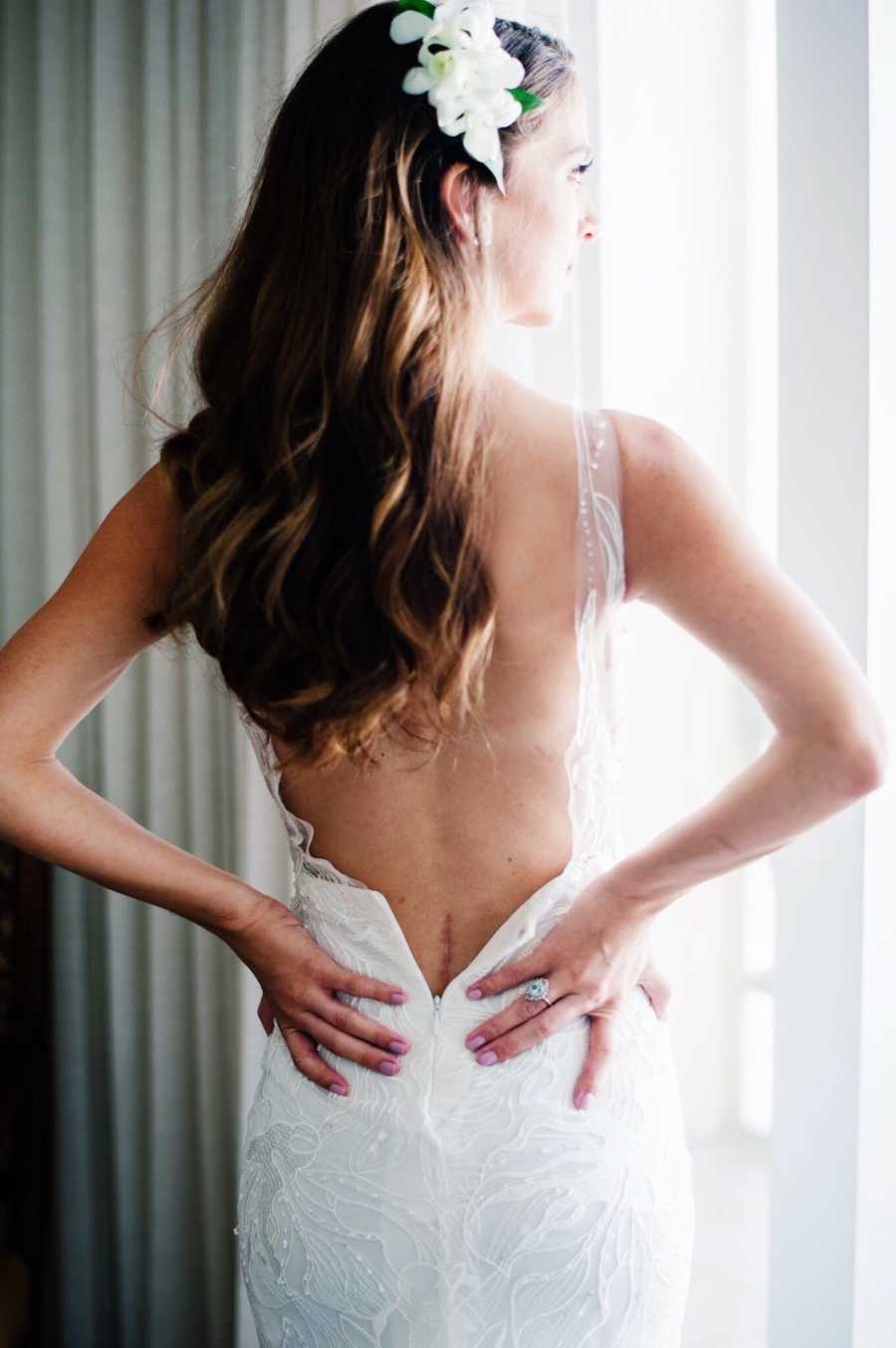Woman stands in wedding gown with dressed not fully zipped to show scar from spinal surgery