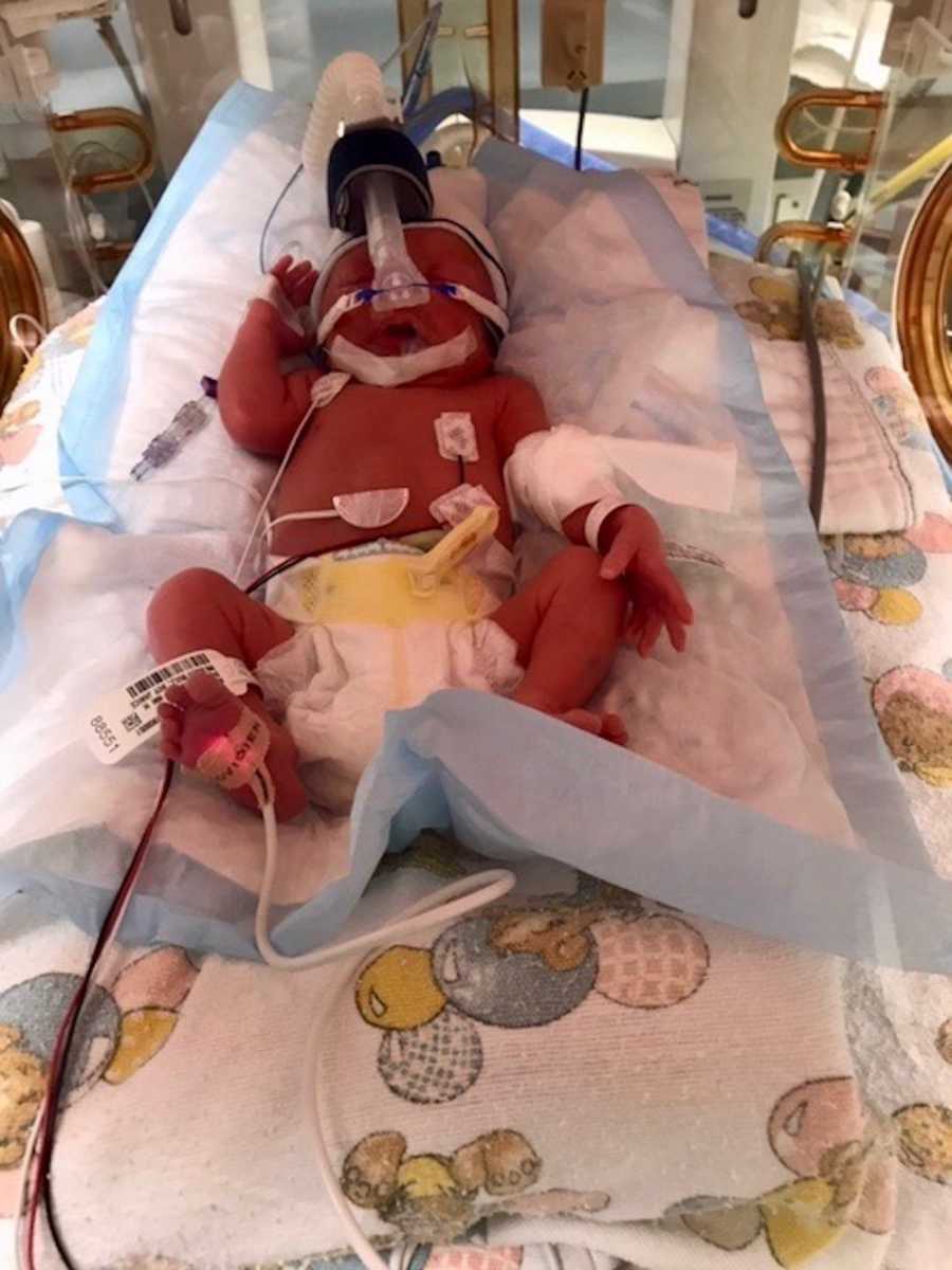 Baby who was born completely in the sac lays in NICU 