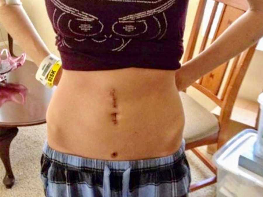 Woman with gastrointestinal problems holds shirt up to show scar from small intestine surgery 