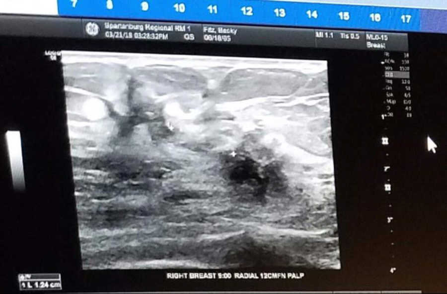 Ultrasound of tumor in woman's breast