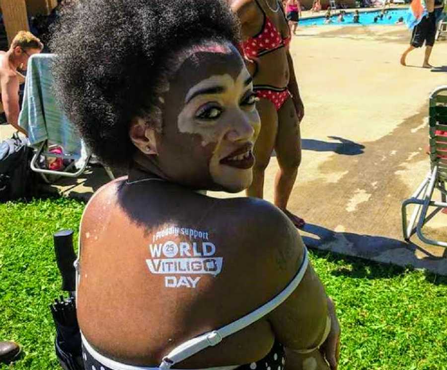 Woman with vitiligo sits at pool without make to show skin pigmentation