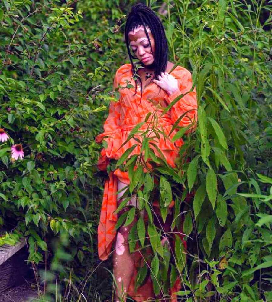 Woman with vitiligo stands in bush of plants