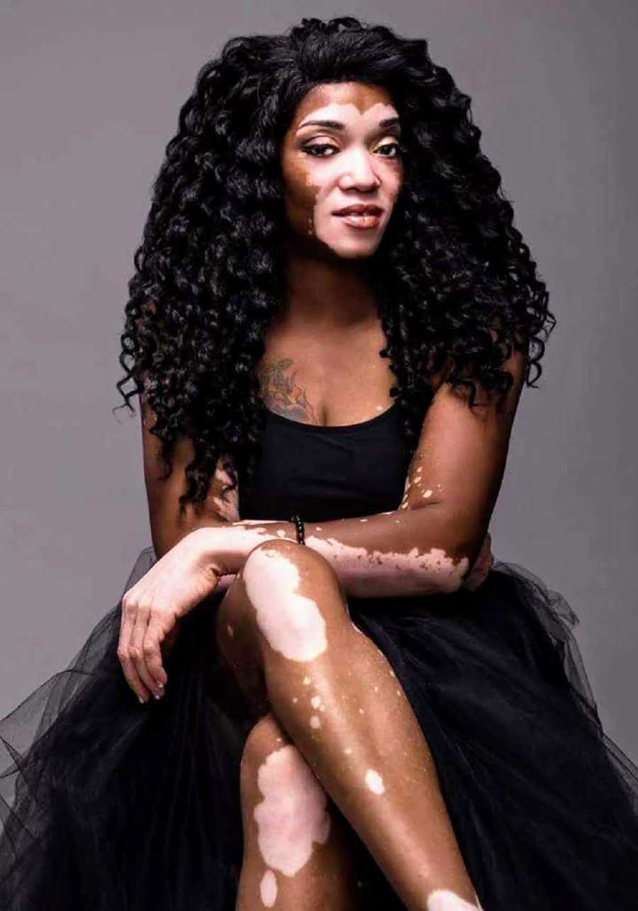 Woman with vitiligo sits in black dress 
