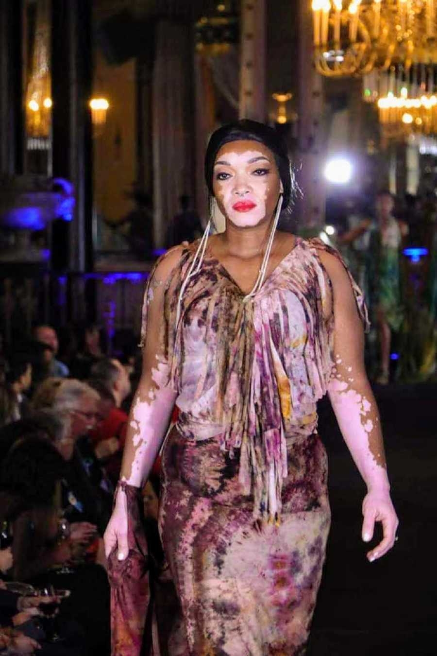Woman with vitiligo walks on runway