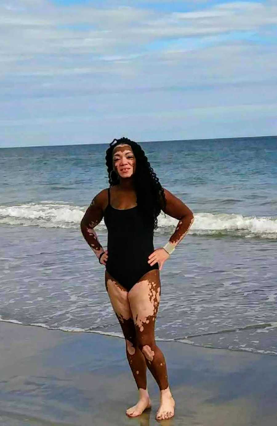 Woman with vitiligo stands on beach in bathing suit with hands on her hips 