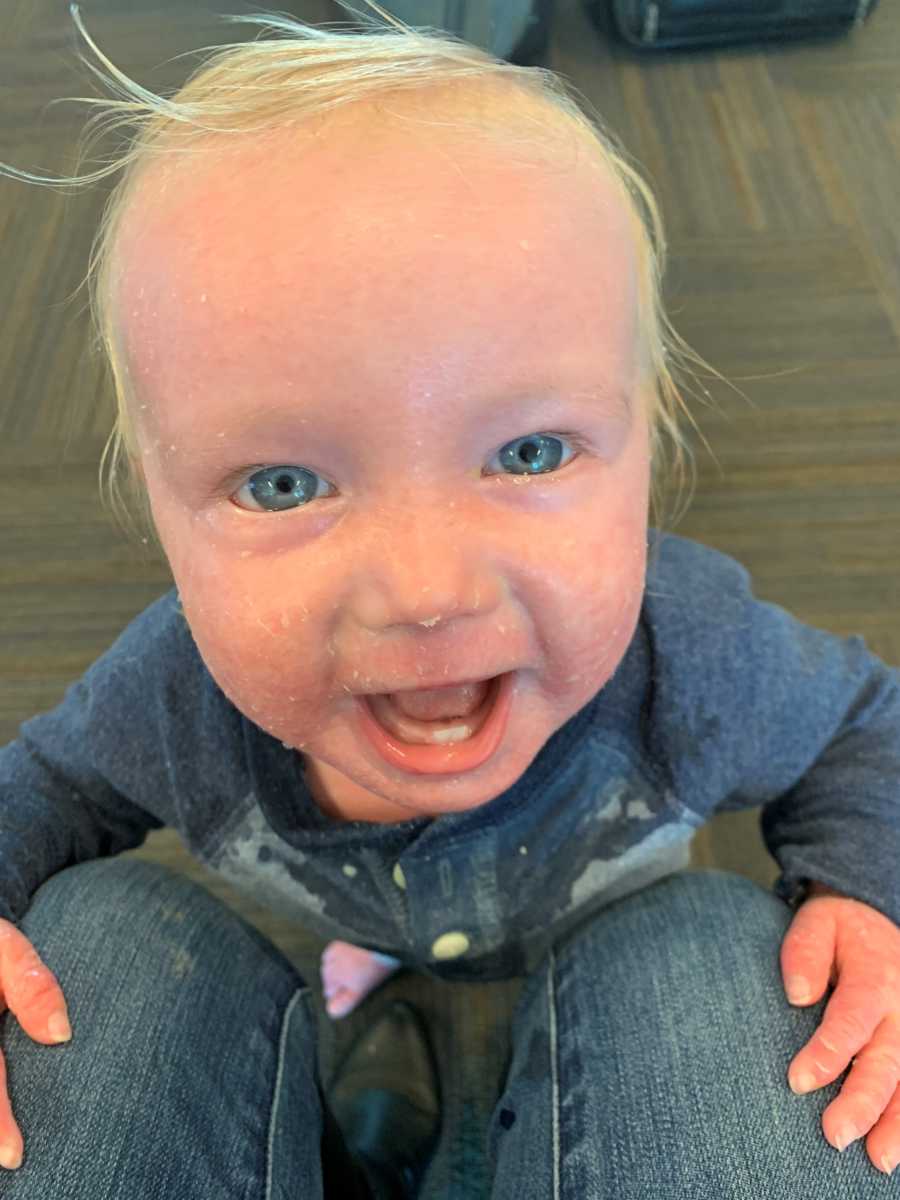 Baby boy with Ichthyosis smiles as he stands in airport holding onto mother's legs