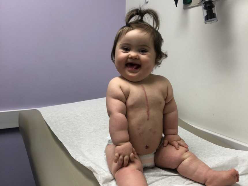 Baby with down syndrome sits up smiling in doctor's office with scar from open heart surgery down middle of her chest
