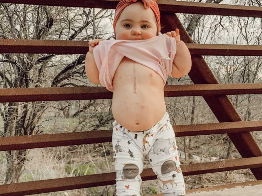 Little girl with down syndrome and who had heart surgery stands outside holding up shirt to show scar