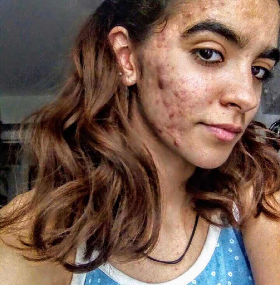 acne_acnescars_bullying_beauty_constanzaconcha13-900x918.jpg