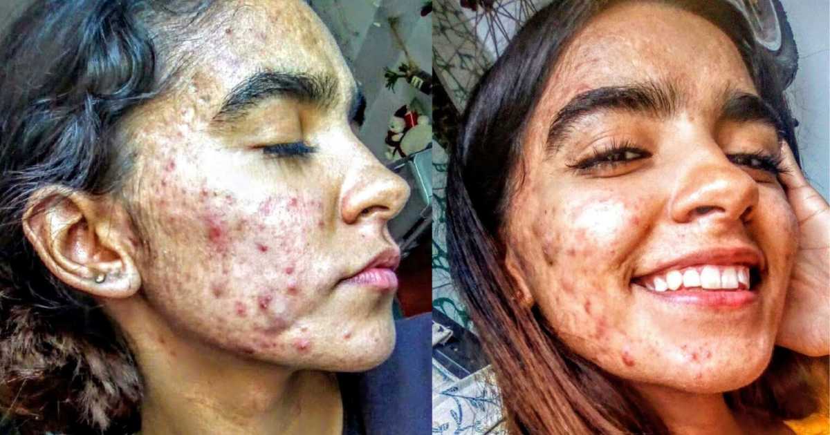 ‘How can your mom kiss you with that face?!’ My cysts were so bad they