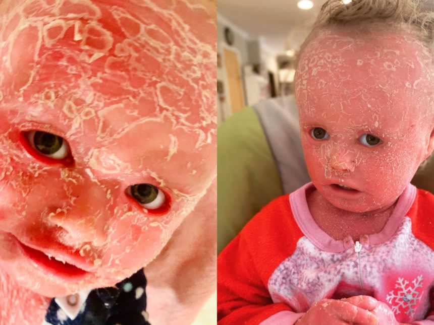 Harlequin Ichthyosis - Love What Matters