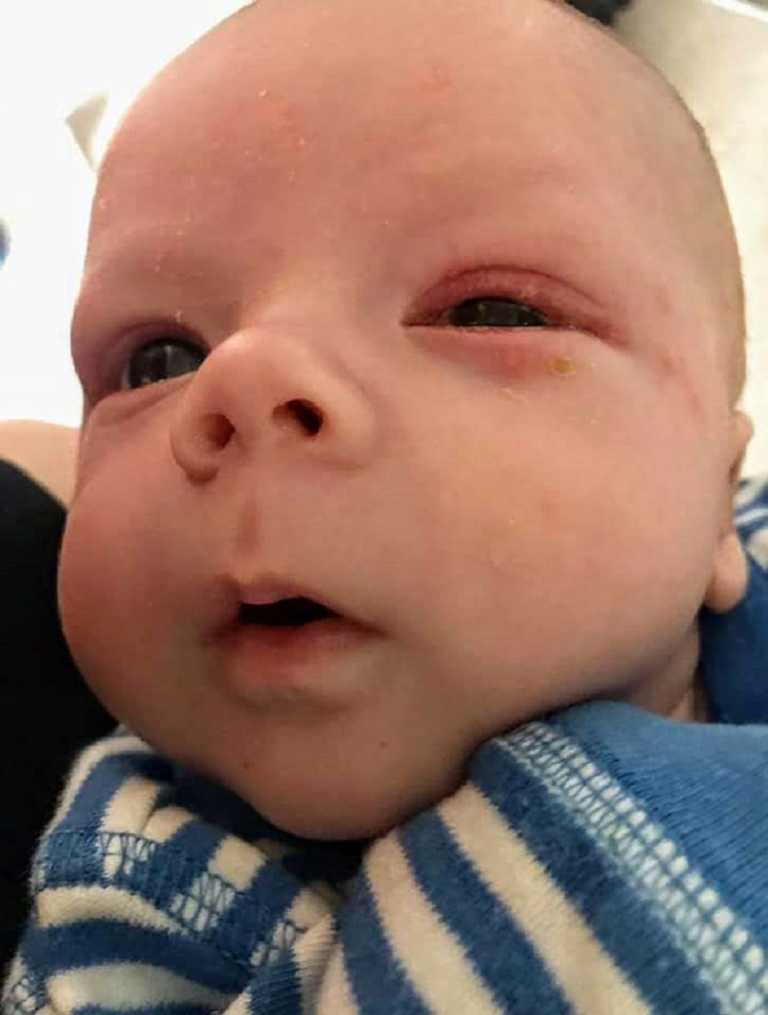 ‘My newborn son got Herpes from a kiss, and nearly died.’ Mom’s 4week