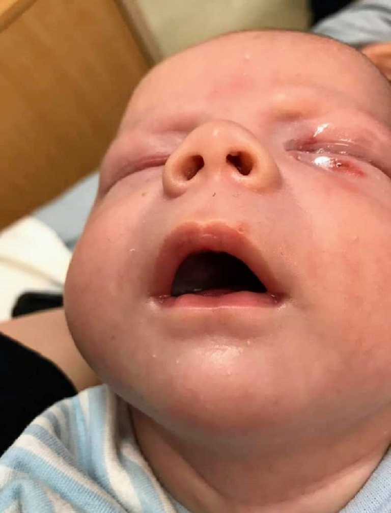 ‘My newborn son got Herpes from a kiss, and nearly died.’ Mom’s 4week