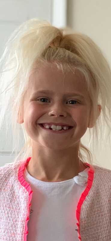 Uncombable Hair Syndrome Vs Black Hair