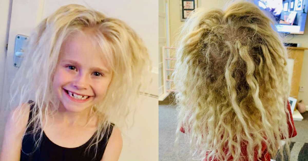 We Nicknamed Her Chucky From The Horror Films Her Hair Got Crazier Bigger Wiry Matted Like It Was Crimped Mom Shocked By Daughter S Wool Like Matted Mess Blonde Hair Learns Of Rare Uncombable