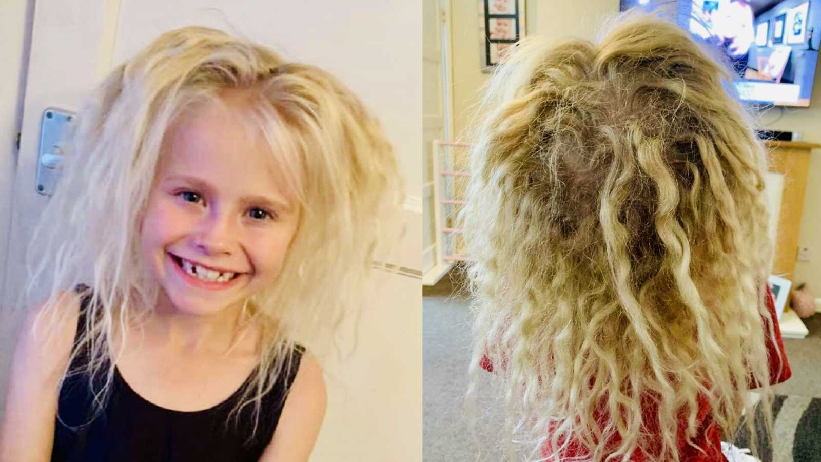 We nicknamed her Chucky, from the horror films!' Her hair got crazier,  bigger. Wiry, matted, like it was crimped.': Mom shocked by daughter's  'wool-like matted mess' blonde hair, learns of rare 'Uncombable