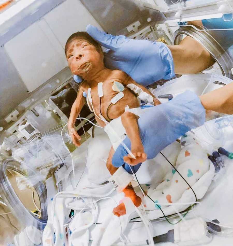 Doctor in blue rubber gloves holding up premature baby 