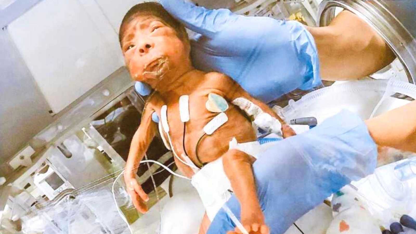 Doctor holding premature newborn baby