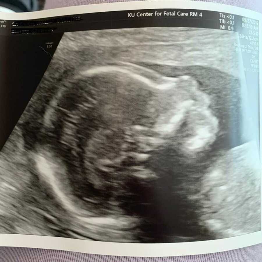 Ultrasound of baby boy