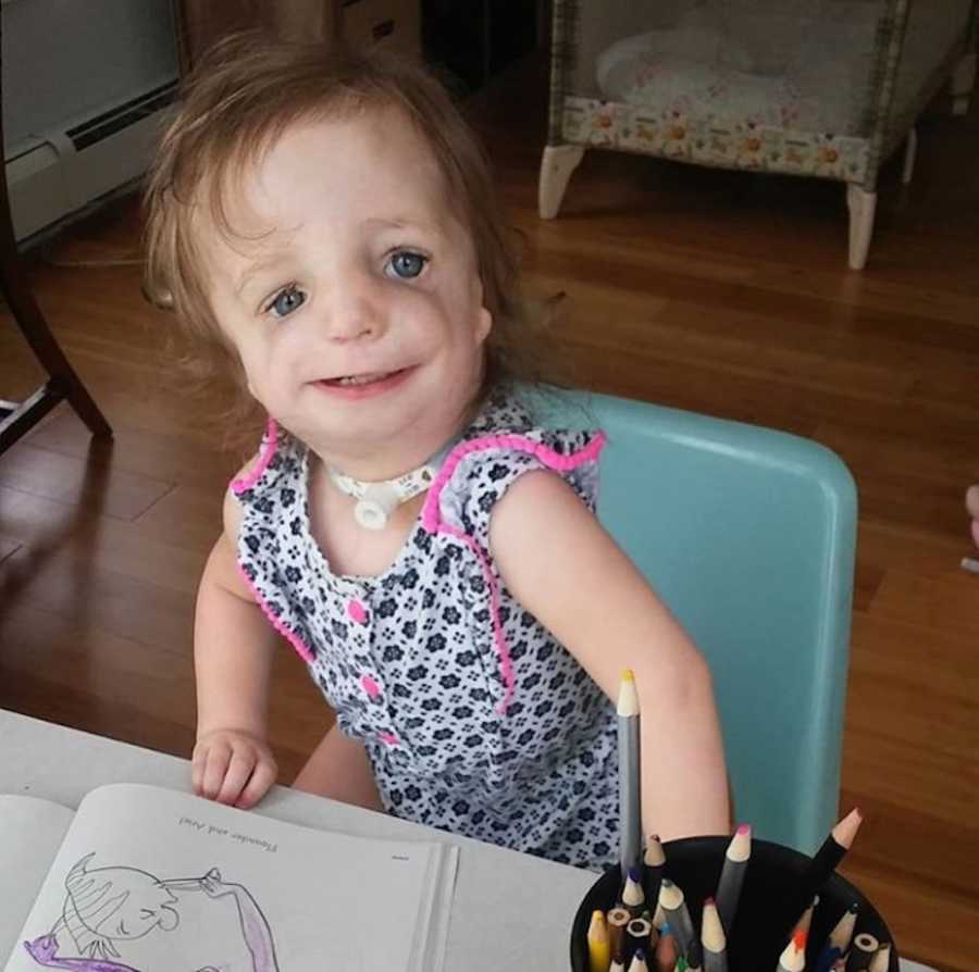 Baby Girl With Treacher Collins Syndrome, ‘Her Disability Won’t Let Her