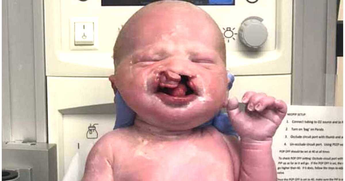 ‘Come on, of all people, you should understand why someone would want to abort a cleft baby.’: Baby has cleft palate surgery, ‘He’s the same boy we fell in love with’